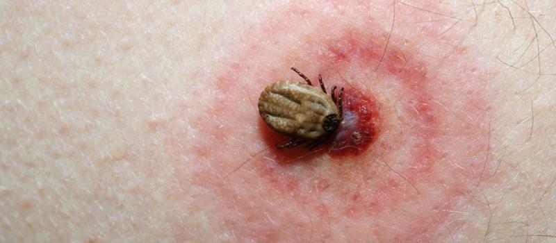 Should I put anything on a tick bite?