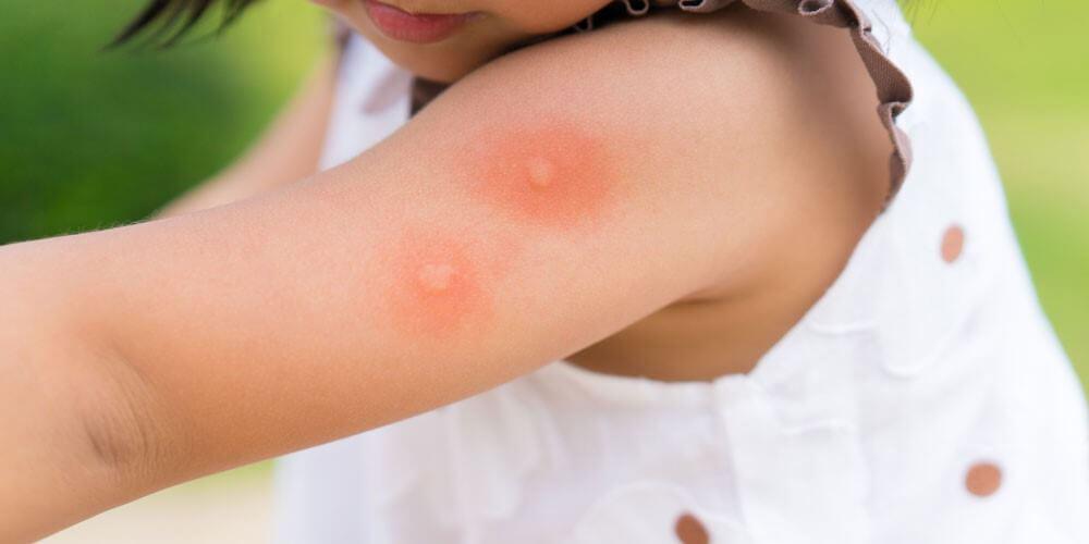 Mosquito bites on little girl's arm 