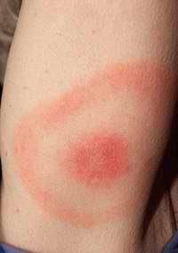 Lyme Disease rash