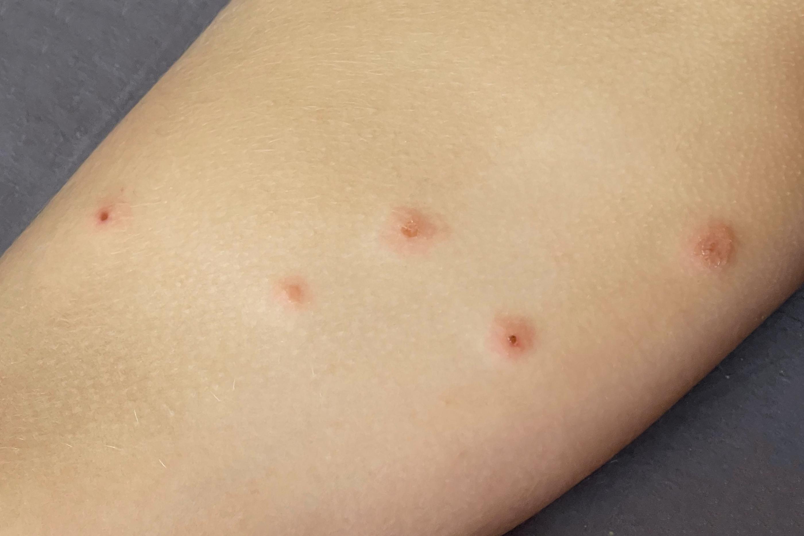 The Difference Between Flea and Bed Bug Bites