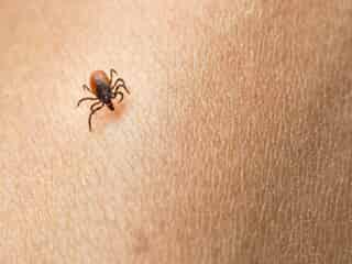 Tick burrowing in skin.