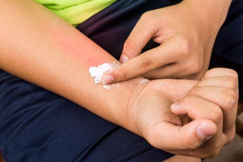 someone applying anti-itch cream to their mosquito bite