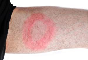 The large red circle could be an indicator of Lyme Disease
