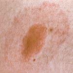 Lyme Disease Rash from deer tick