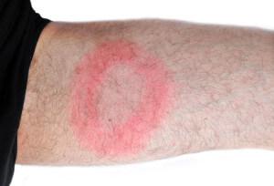 The large red circle could be an indicator of Lyme Disease