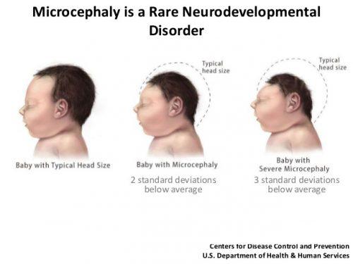 Zika Tied to Birth Defects in U.S.