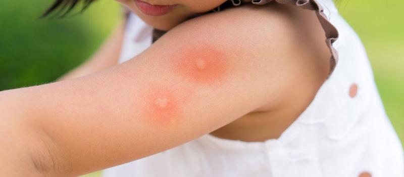The Best Ways to Soothe Mosquito Bites