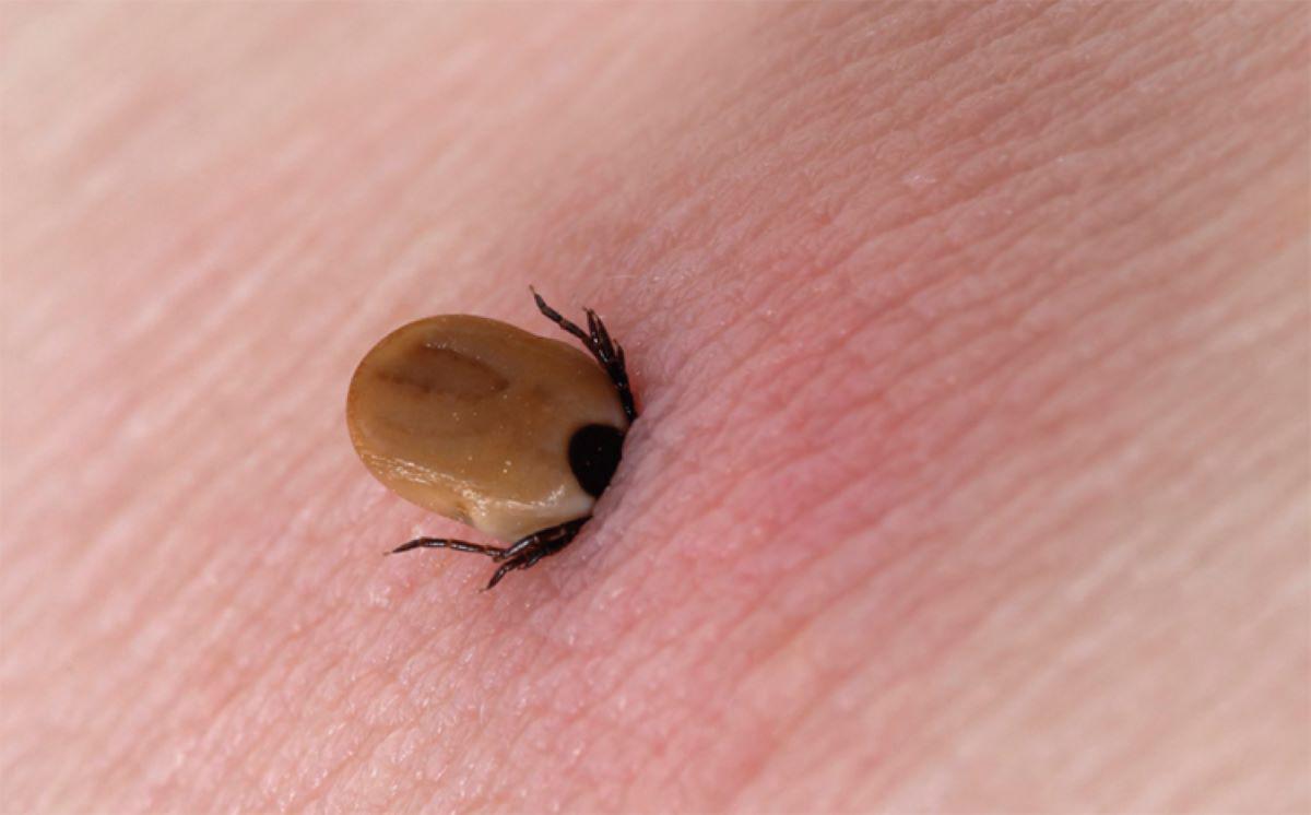 Mosquito Squad SE Massachusetts embedded tick in skin