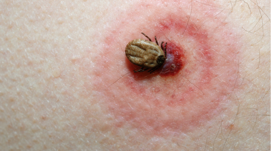 Is Lyme Disease Here? Why Birmingham Tick Control is Vital