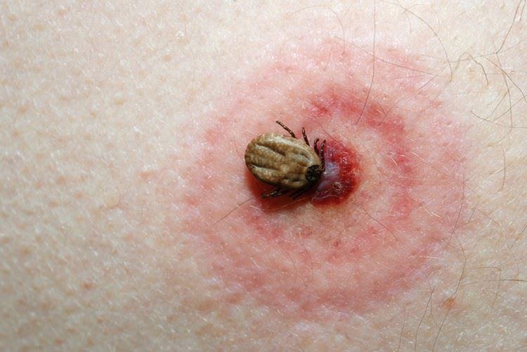 Tick biting the skin 