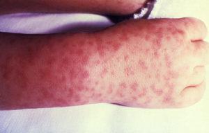disease on skin