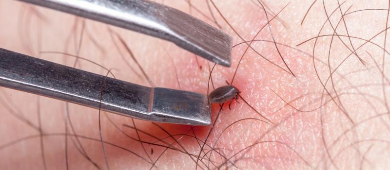 How Do You Know if a Tick Head is Still in Your Skin?