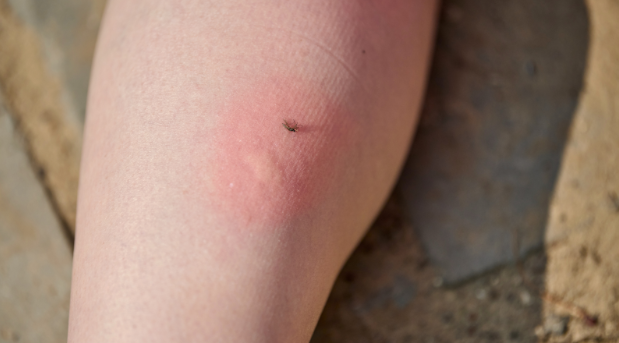 Mosquito Bites are Itchy, Here’s Why