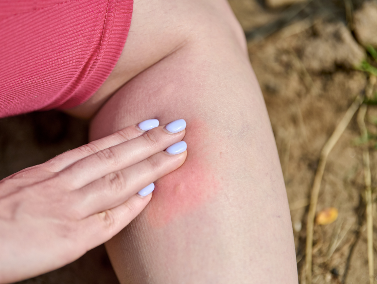 Tips for Preventing Mosquito Bites