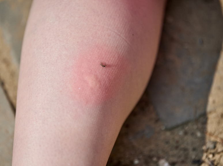 Mosquito-Borne Illnesses in NE Minnesota