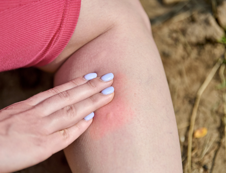Are Mosquito Bites Worse in Some Areas?