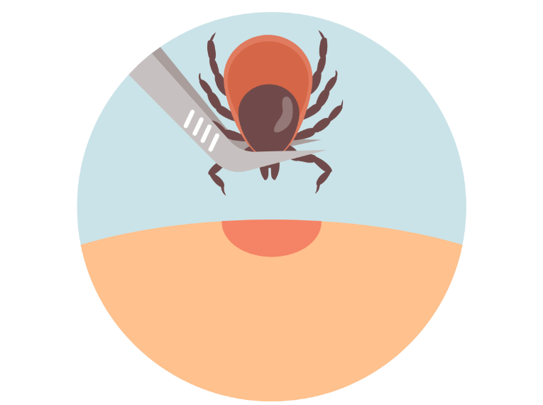 Alpha-Gal Syndrome & Lone Star Ticks