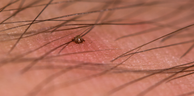 What You Should Know about Tick Bites this Summer