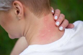 a woman with mosquito bites on her neck  